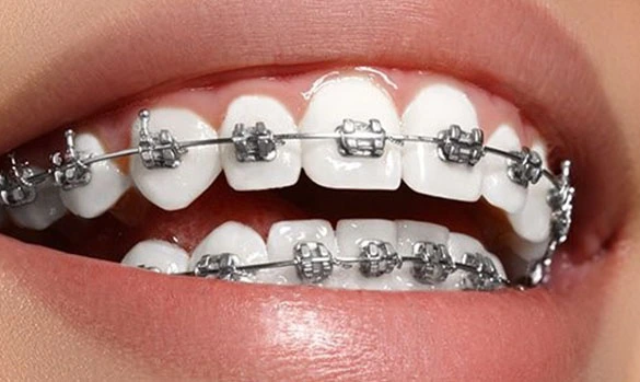 Ortodonti (Diş Teli Tedavisi)